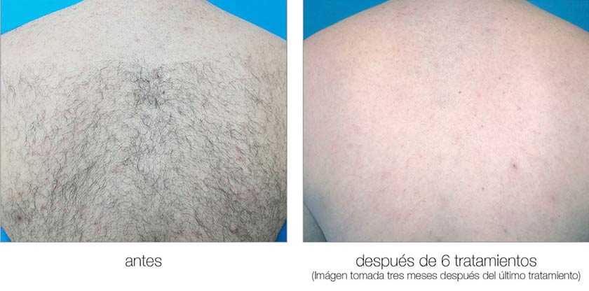 Comparación original publicada por Meditet: espalda antes y después del tratamiento