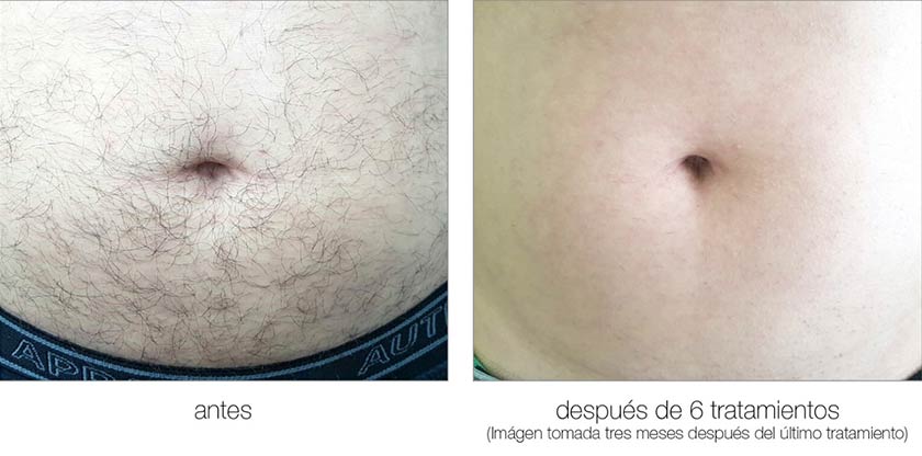 Comparación original publicada por Meditet: pecho antes y después del tratamiento