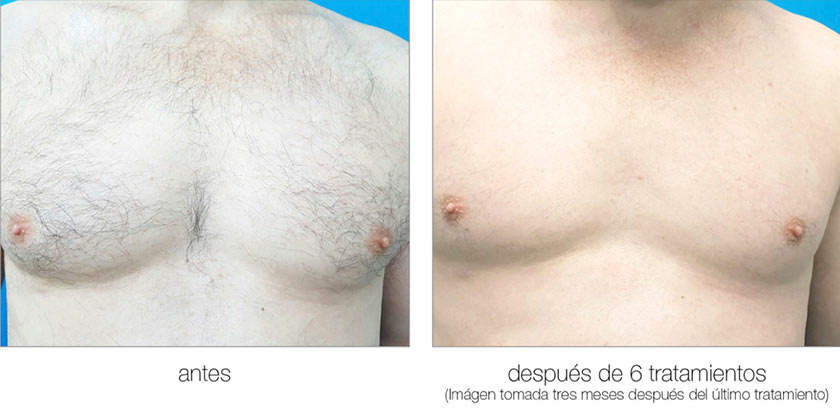 Comparación original publicada por Meditet: abdomen antes y después del tratamiento